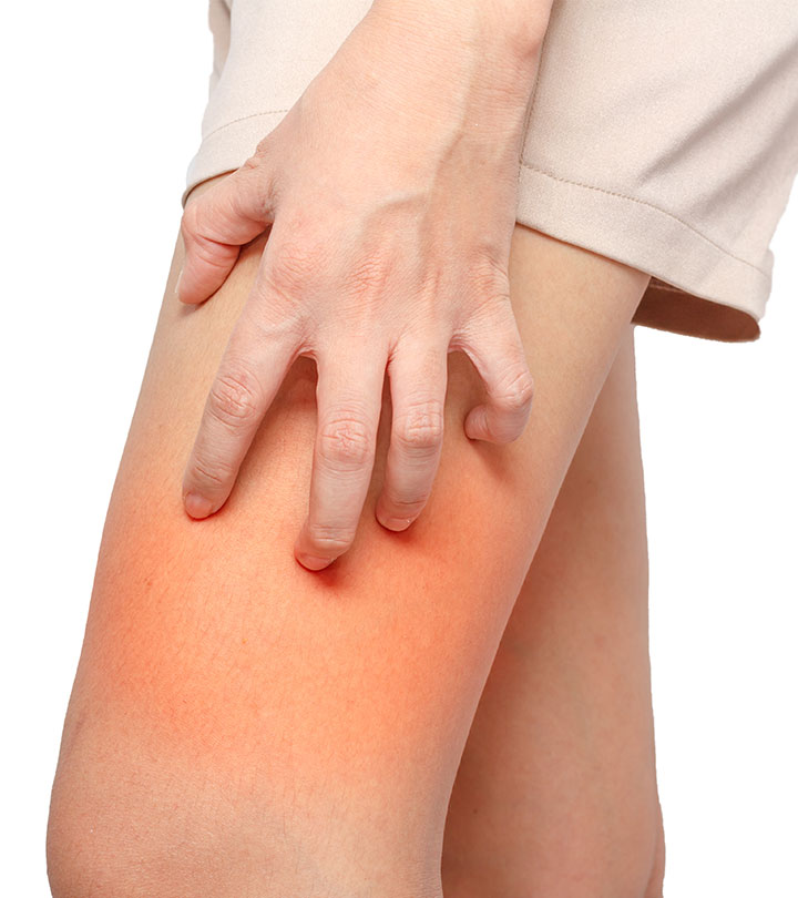 Best Home Remedies To Treat And Prevent A Chafing Rash