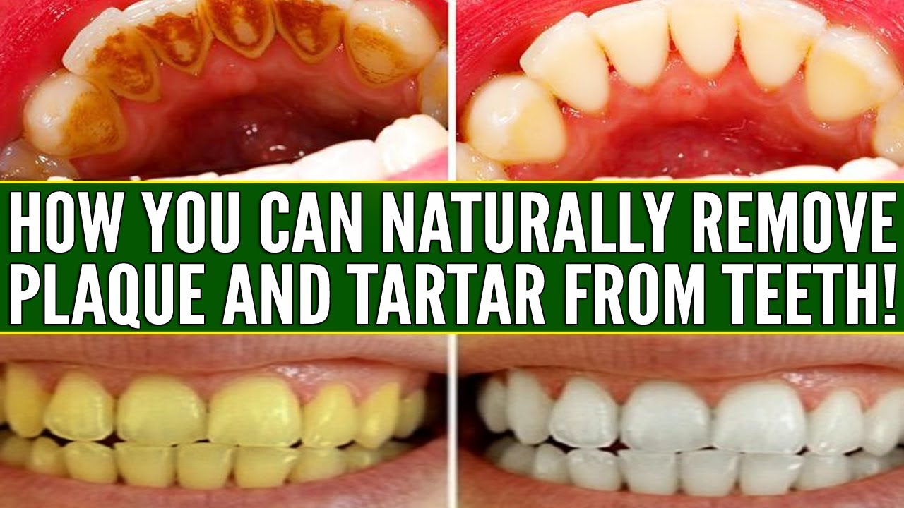 11-effective-natural-remedies-to-remove-tartar-and-plaque-on-teeth