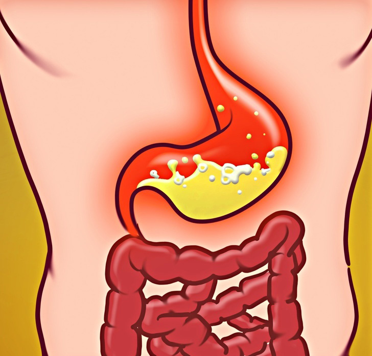 6 Signs You’re Suffering From Acid Reflux And How to Fix It