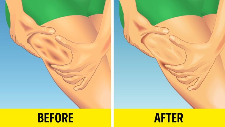 5 Tips from Dermatologists How to Reduce Cellulite That Actually Work