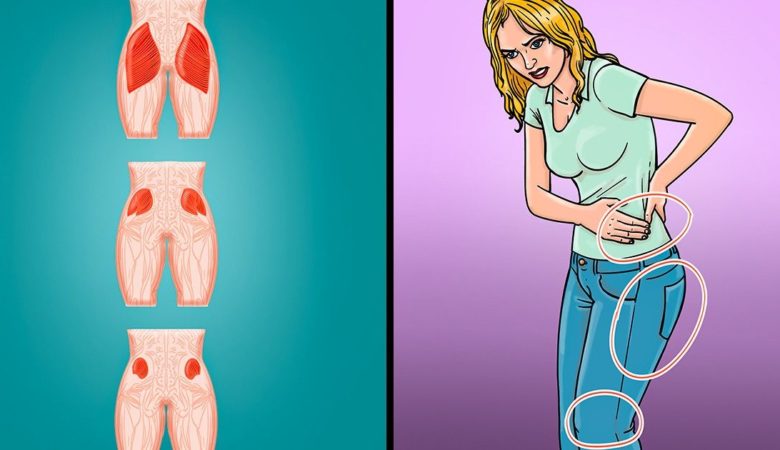 What Is Dead Butt Syndrome and How to Avoid It