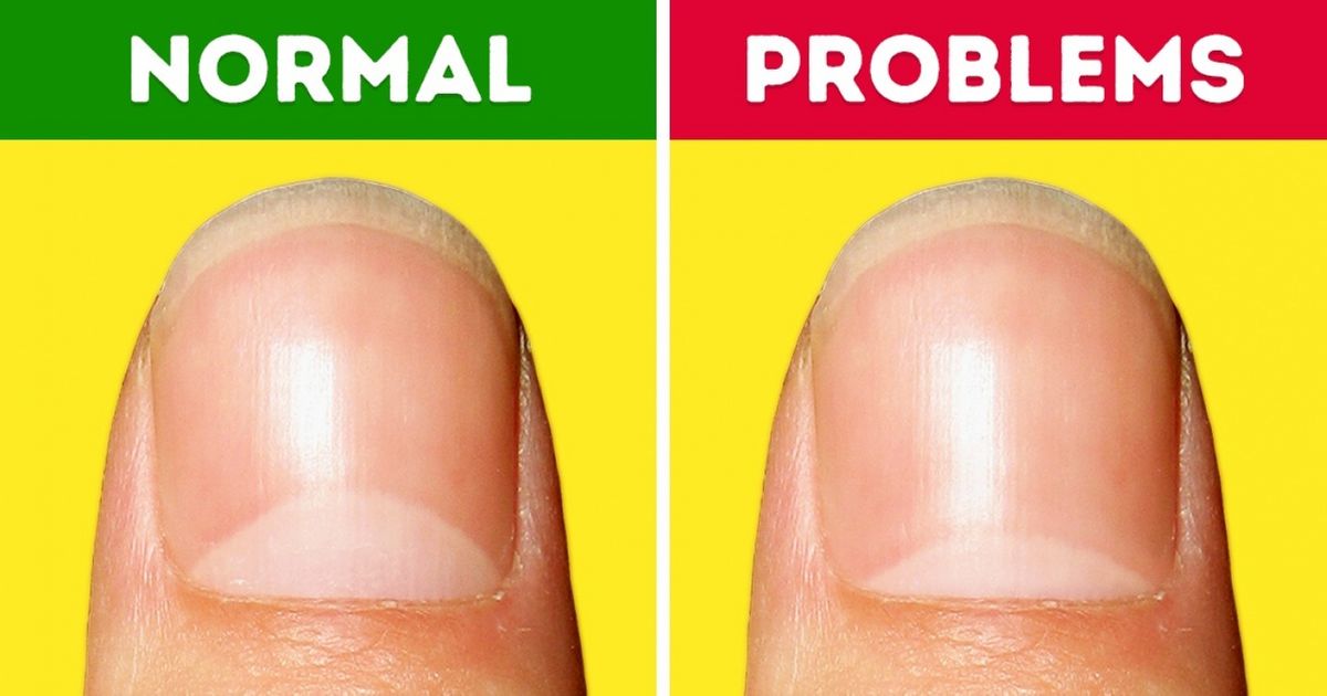 10 Health Problems the Moons on Your Nails Warn You About