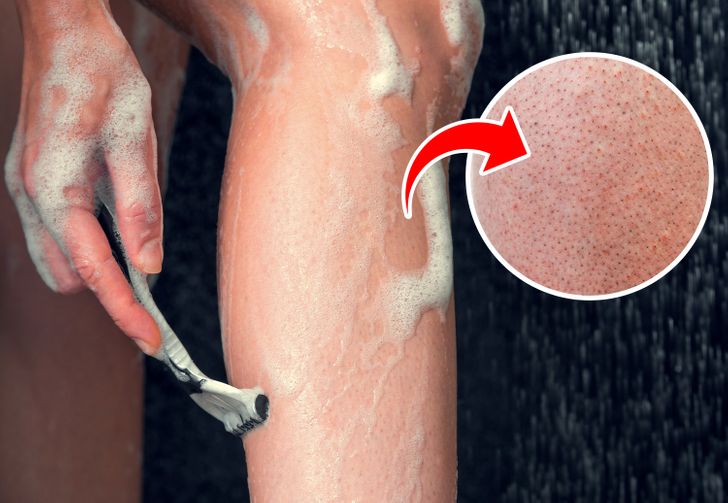 What Causes Strawberry Legs and How to Get Rid of It