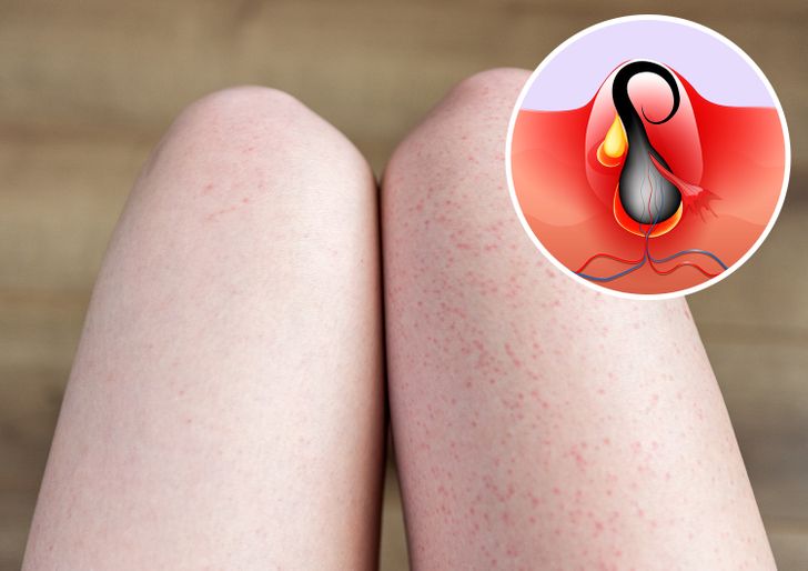 What Causes Strawberry Legs and How to Get Rid of It