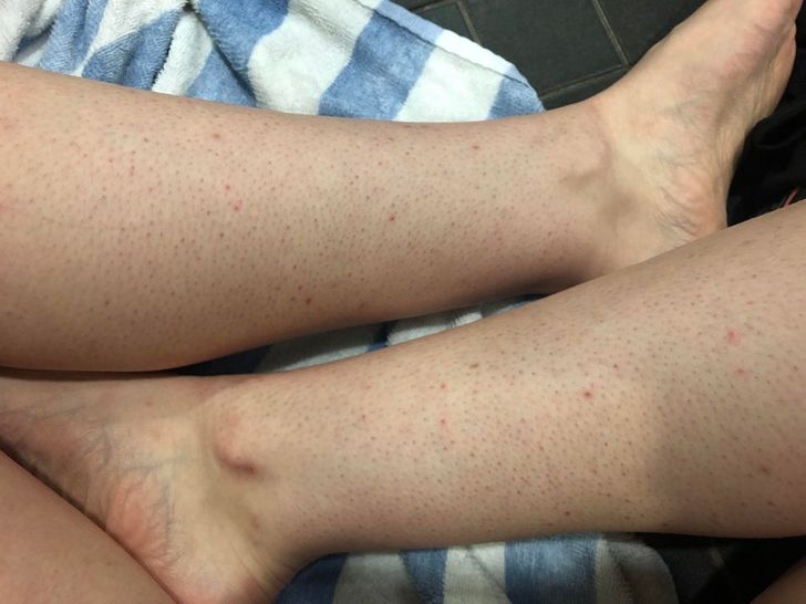 What Causes Strawberry Legs and How to Get Rid of It