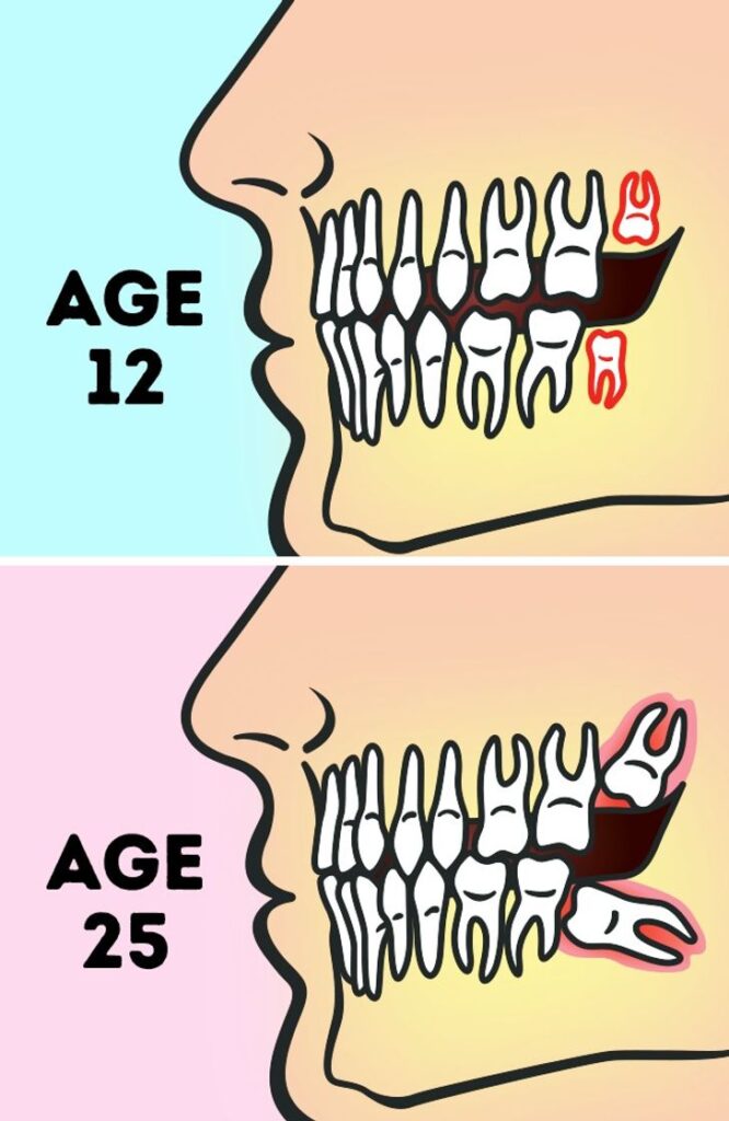 Do We Really Need to Remove Wisdom Teeth?