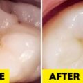 Dentists Reveal 8 Simple Ways to Prevent Tooth Decay