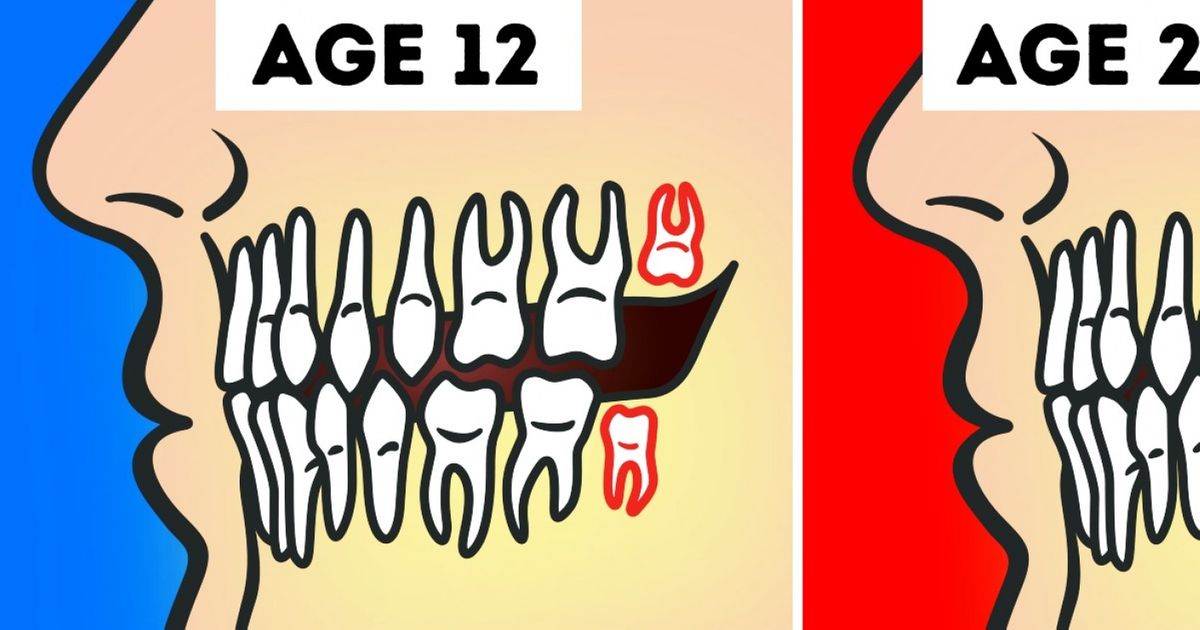 Do We Really Need to Remove Wisdom Teeth?
