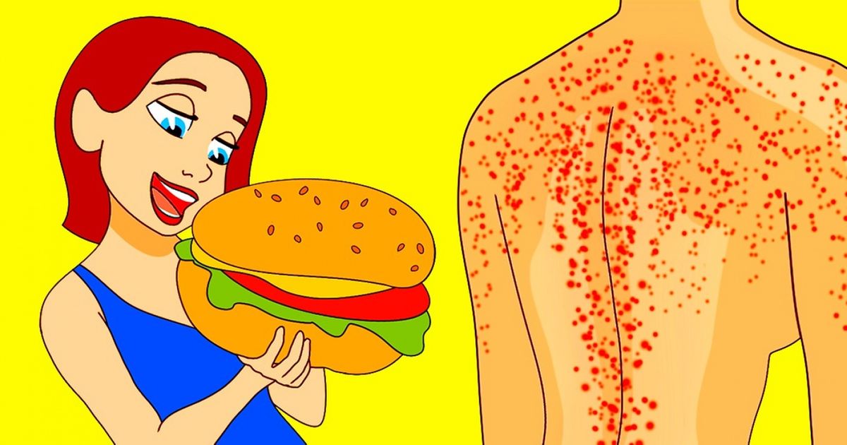 5 Hidden Causes of Acne and Ways to Get Rid of It