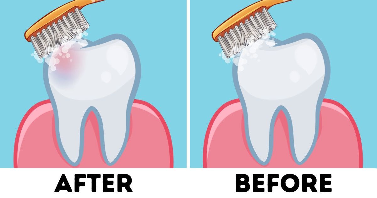 Should You Brush Your Teeth Before or After Breakfast?