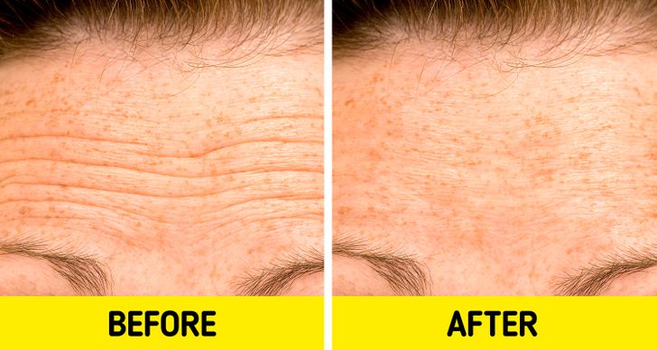 5 Natural Remedies to Make Forehead Lines Less Visible