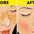 Best Way To Get Rid Of Acne Scars And Pimple Marks Naturally
