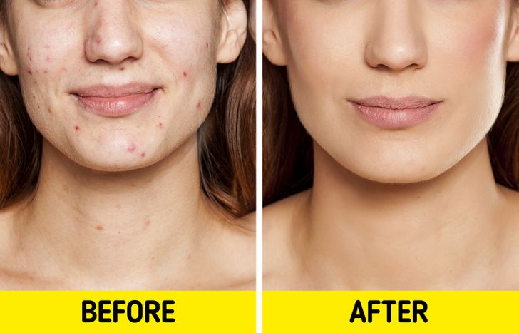 5 Natural Ways to Get Rid of Pimples and Make Your Skin Happy