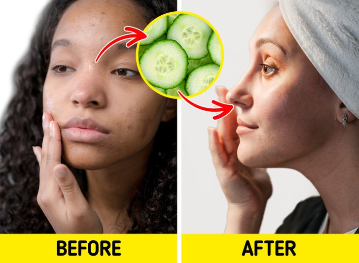 5 Natural Ways to Get Rid of Pimples and Make Your Skin Happy