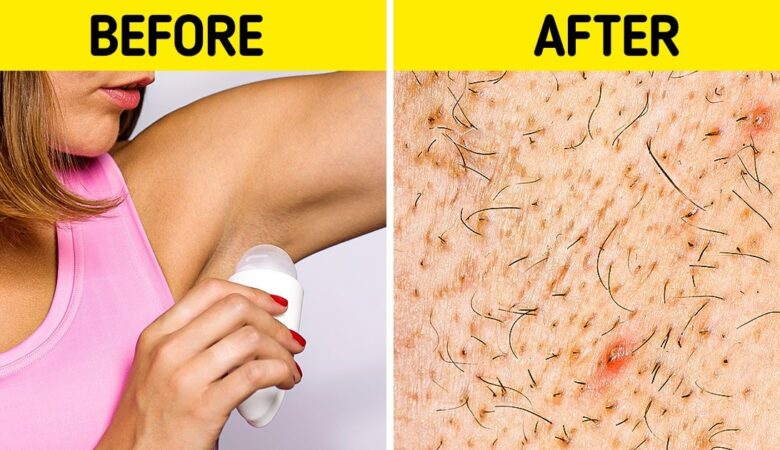 6 Ways to Get Rid of Ingrown Hairs Once and for All