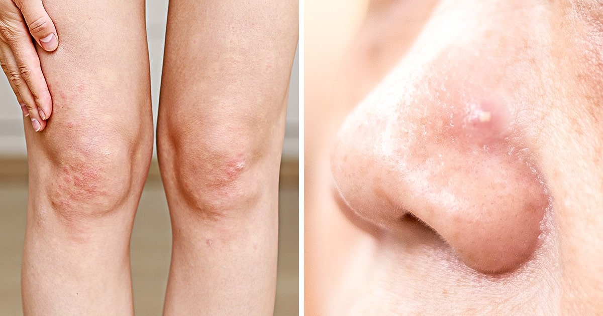What the Acne on 5 Body Parts Is Trying to Tell You About Your Lifestyle Habits